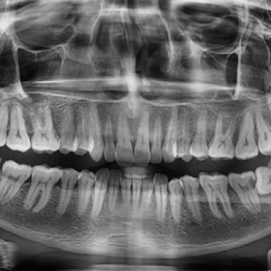 Why do we need to take x- rays for dental treatment?