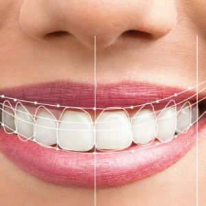 Thinking about clear braces?
