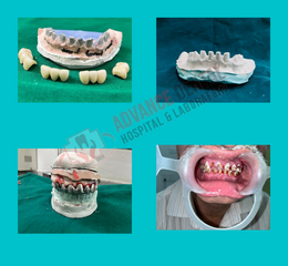 Full Mouth Rehabilitation at Advance Dental Hospital , Nagpur