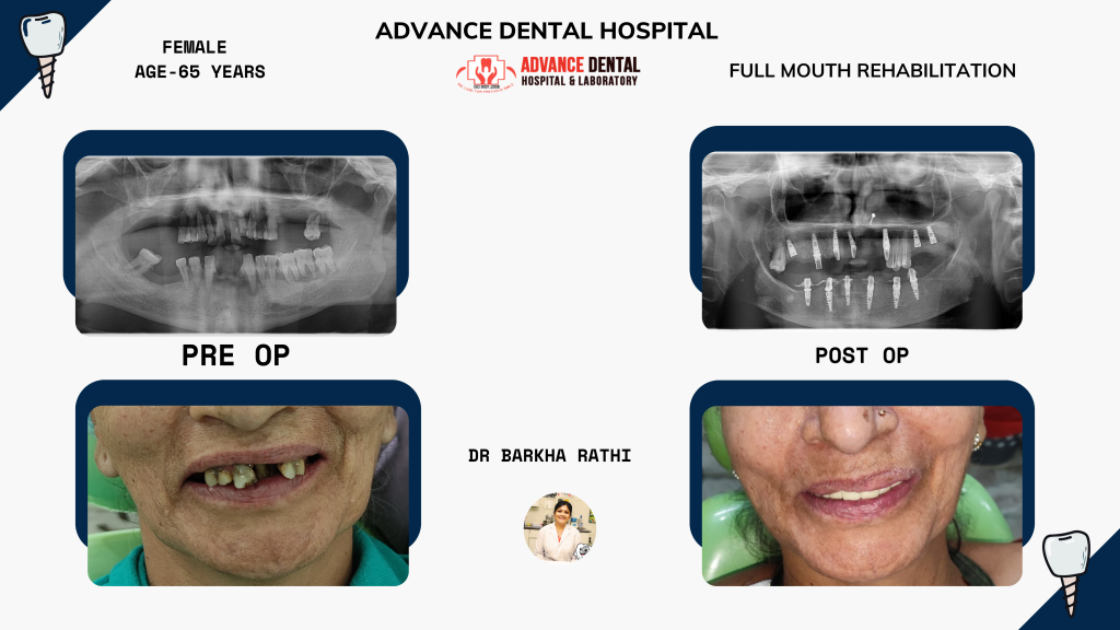 Dental implant in nagpur