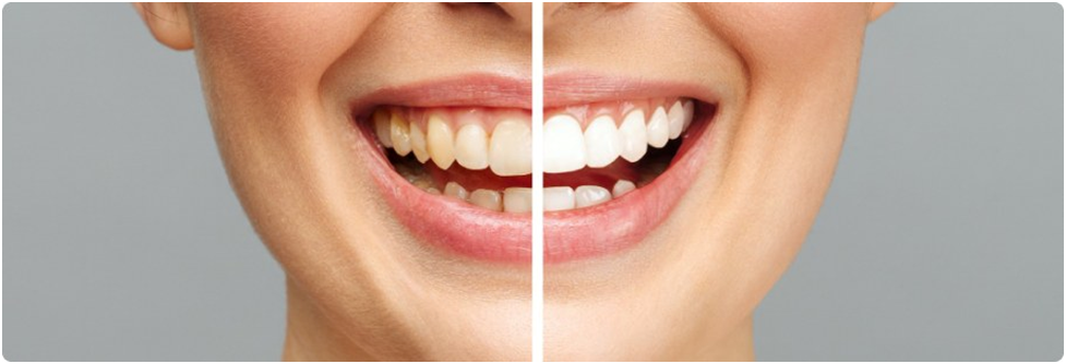 Teeth-whitening-treatments 
