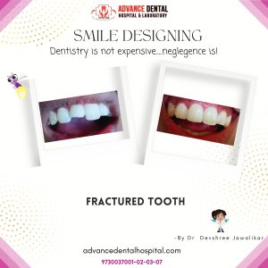 Teeth Whitening Treatments in Nagpur: Brighten Your Smile Safely