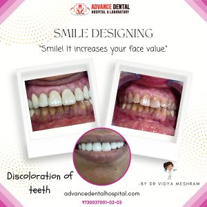 dental implant clinic in nagpur