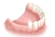 multiple implant
