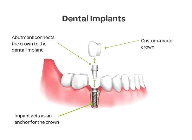 implant 2